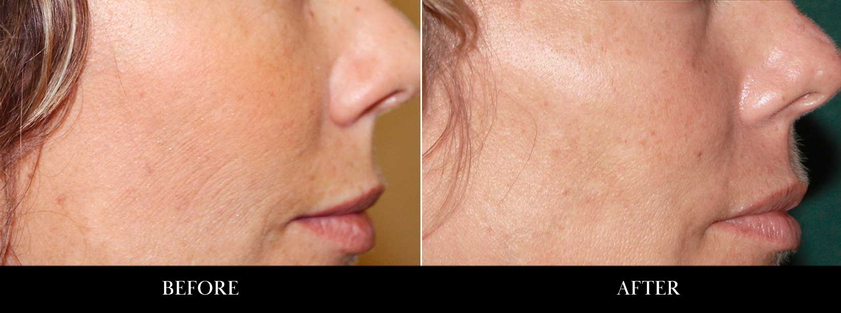 Microneedling treatment before and after pictures.