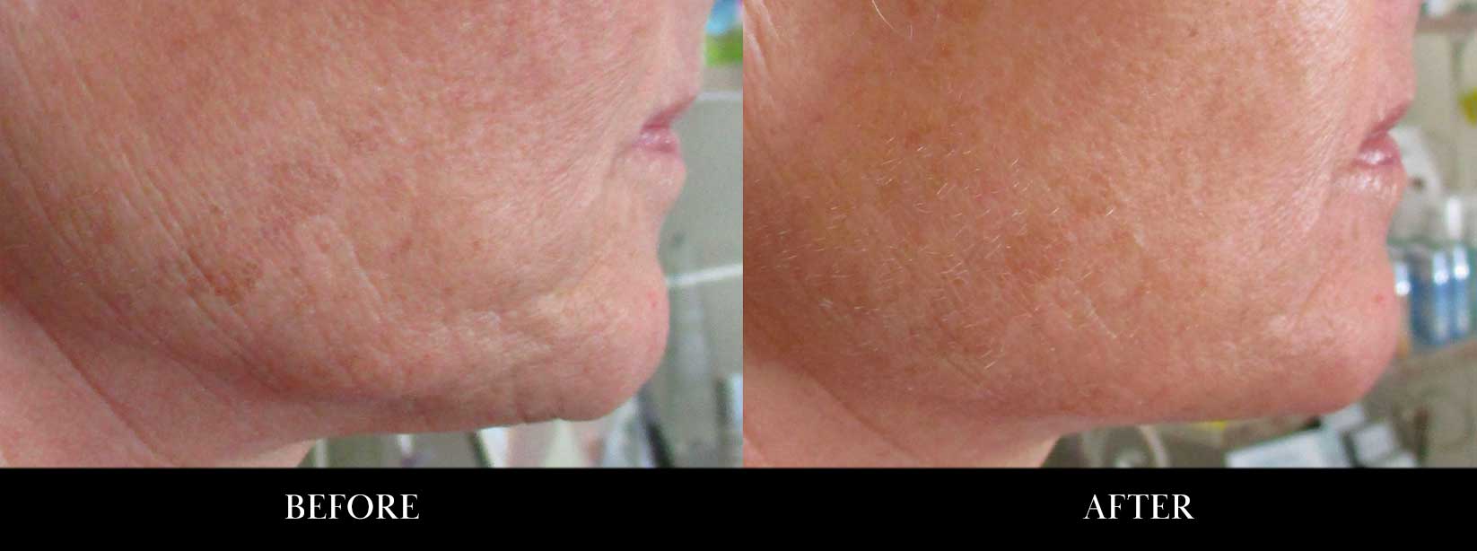 Before and after photos of Secret RF microneedling.