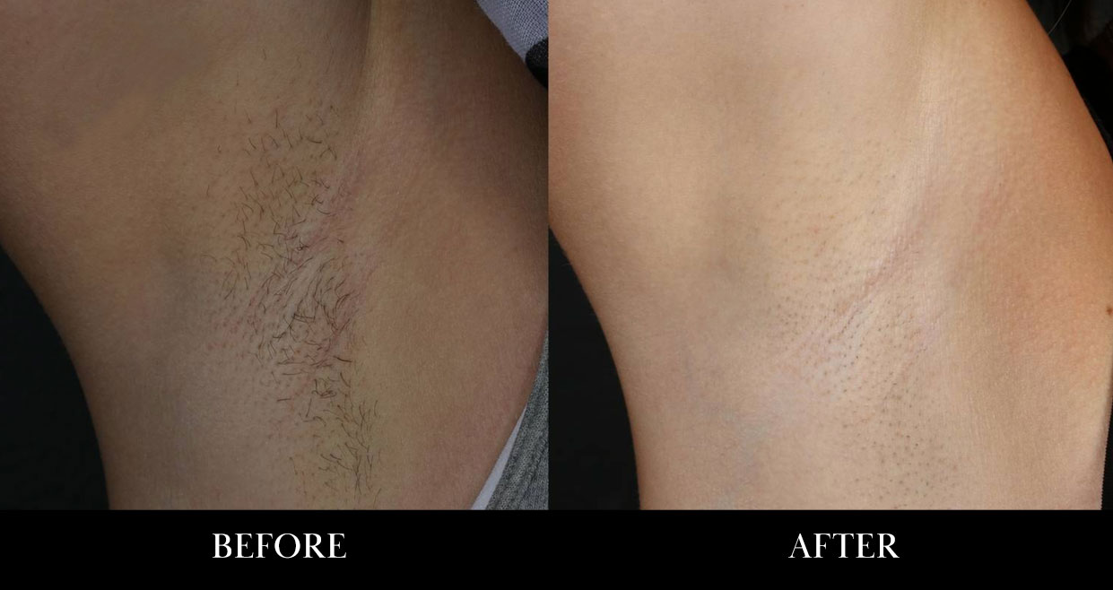 Before and after photos of underarms laser hair removal treatment.