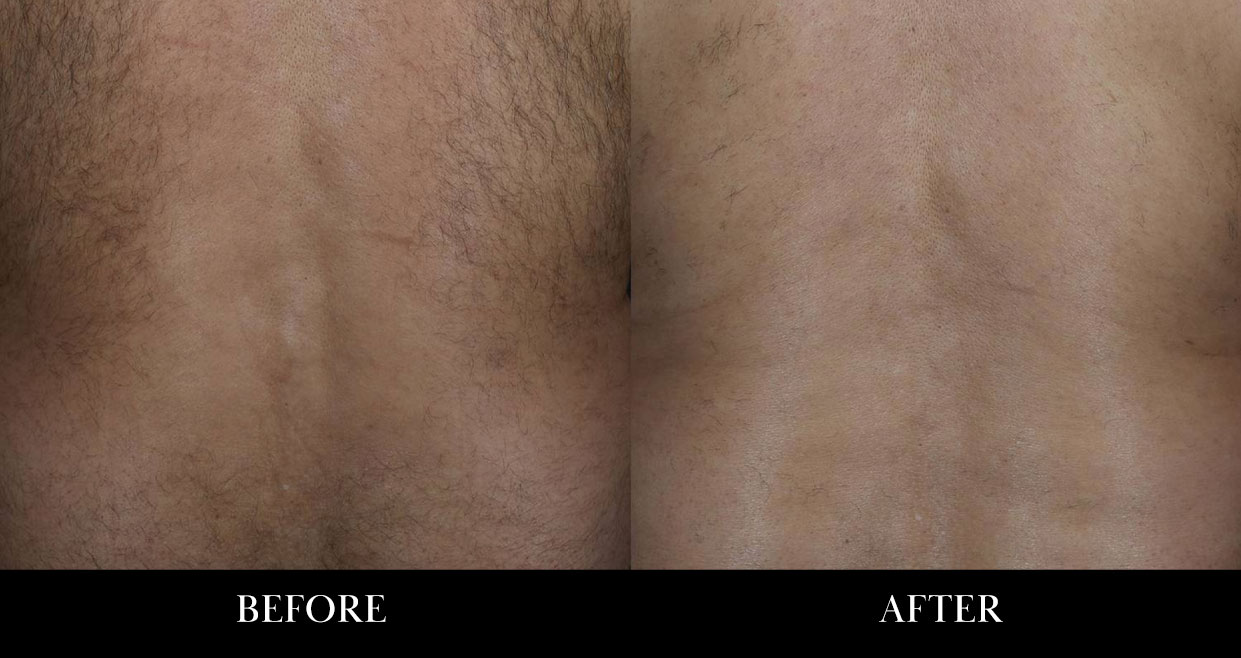 Back laser hair removal before and after pictures.
