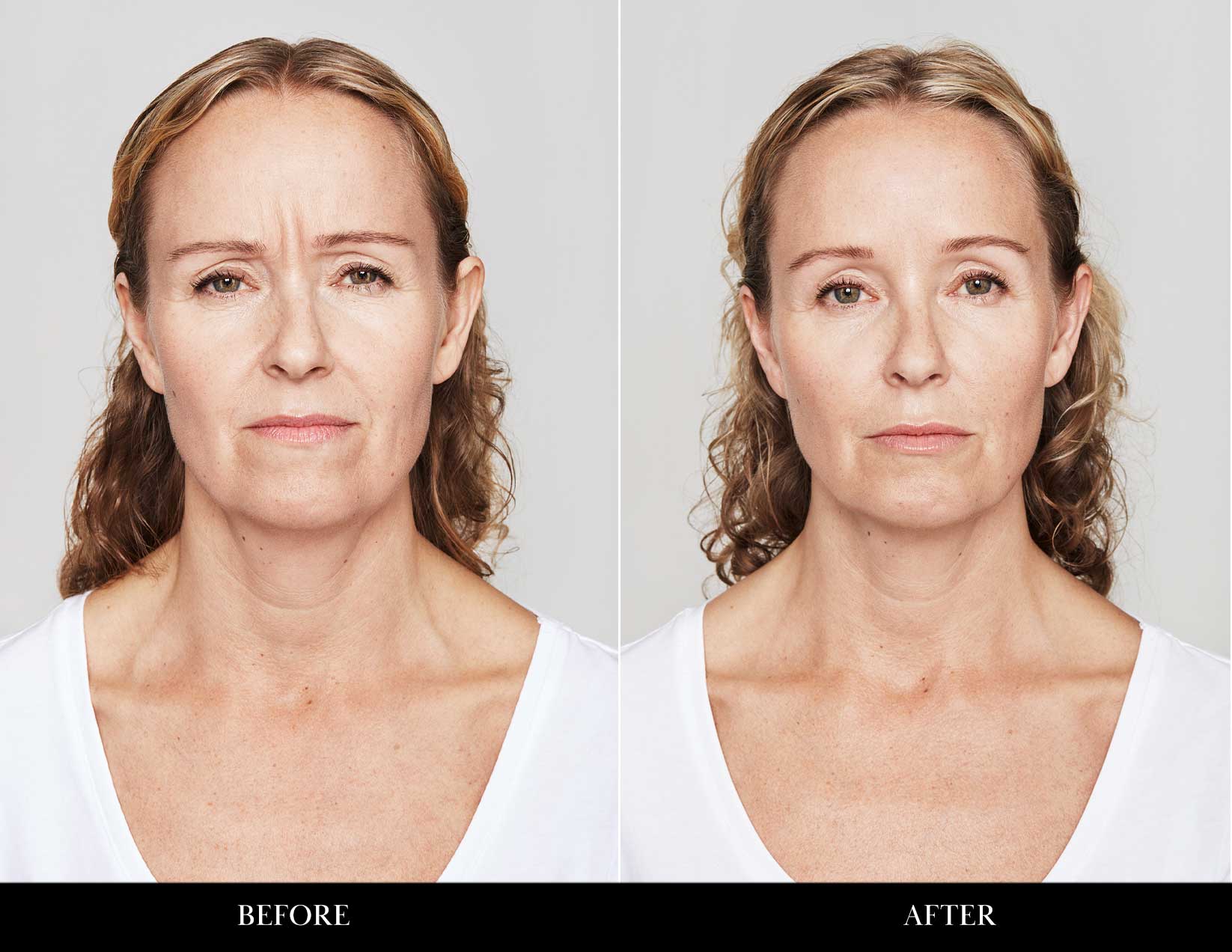 Laser rejuvenation before and after pictures.