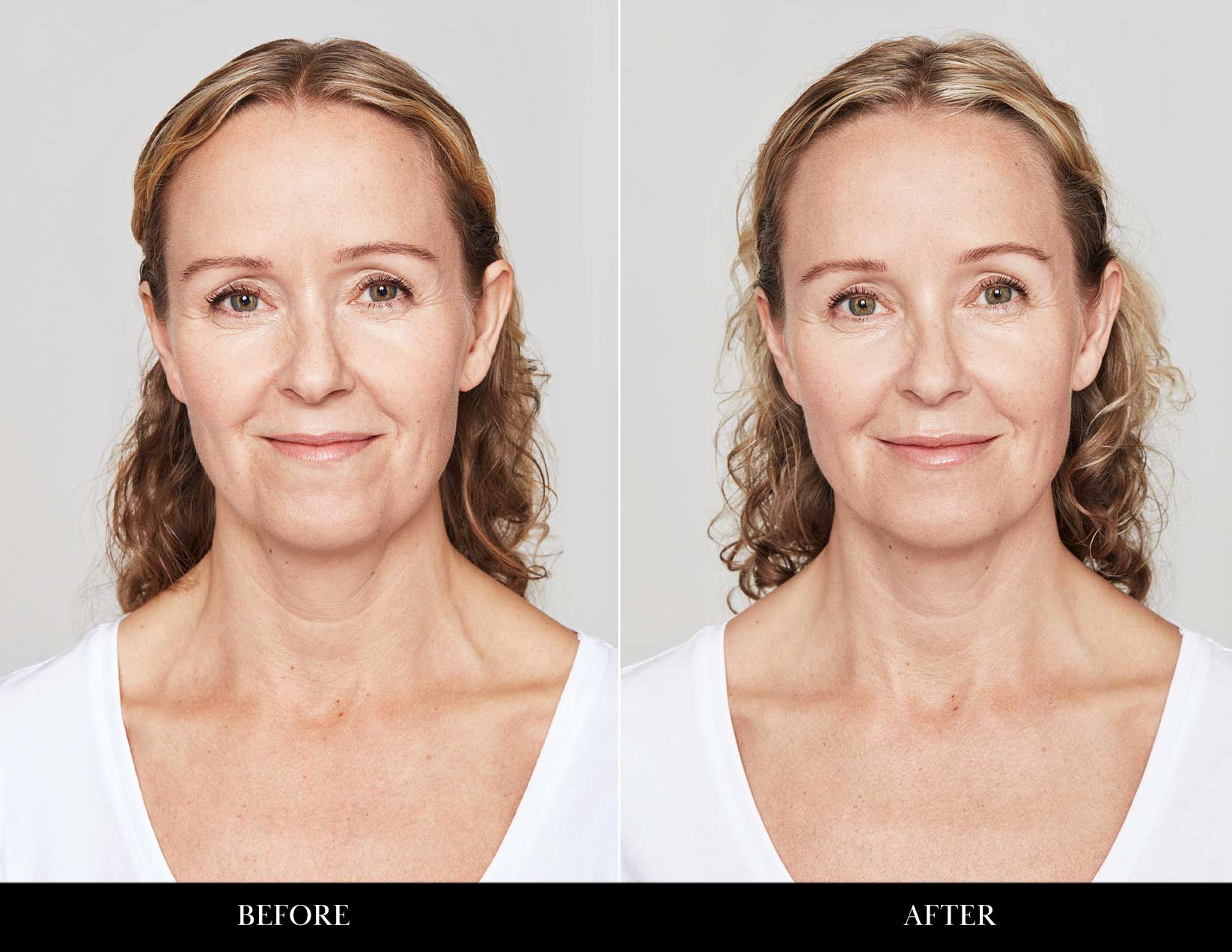 Before and after photos of Laser Genesis treatment.
