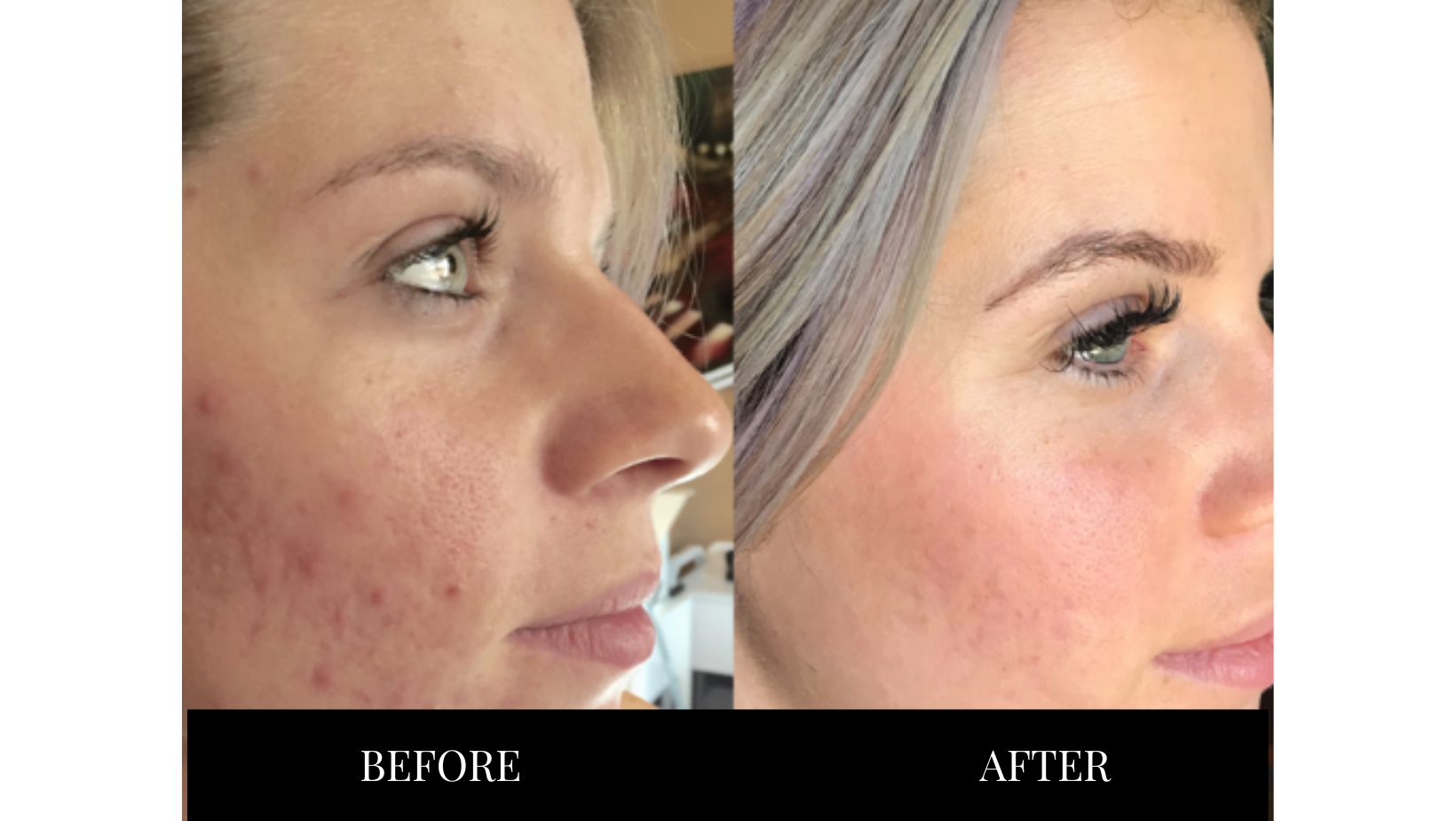 Microneedling treatment before and after pictures.