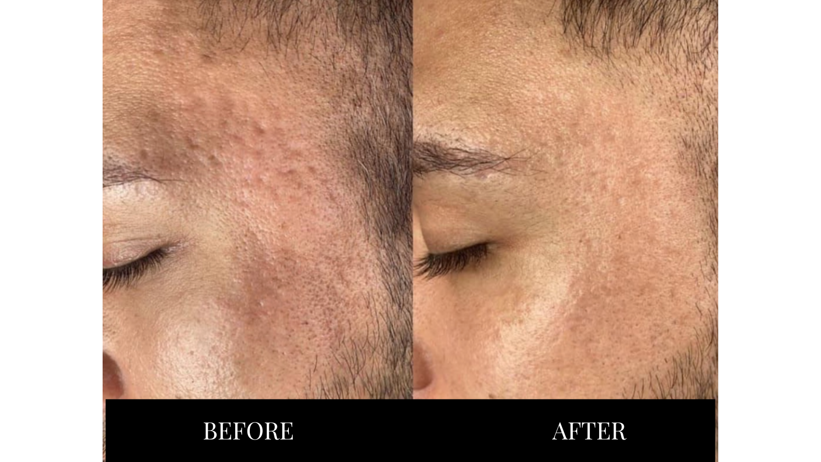 Before and after photos of Secret RF microneedling.